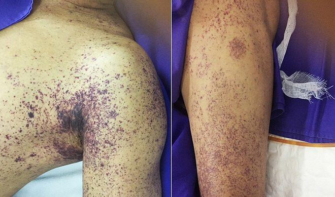 Lại có người tử vong vì ăn tiết canh