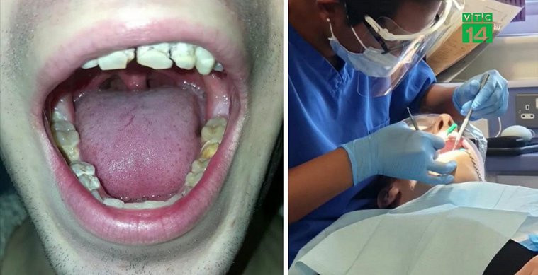 Nghiện nước tăng lực, chàng trai bị mục nát hàm răng
