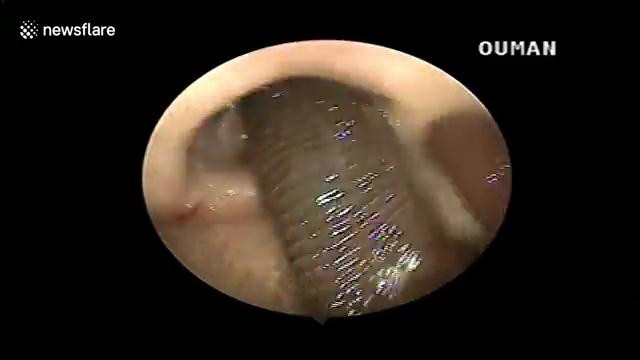  Gắp đỉa dài 10 cm sống ngoe nguẩy ra khỏi mũi người phụ nữ ở Nghệ An