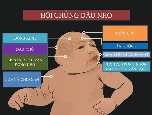 Những di chứng của virus Zika trên trẻ sơ sinh. Ảnh: MĐTT.
