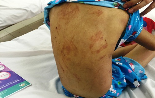 Những lằn roi ngang dọc trên người bé gái 8 tuổi. Ảnh: Hải Hiếu