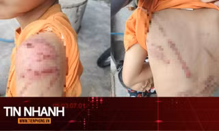 TIN NHANH: Lý do người cha đánh con 10 tuổi bầm tím khắp người
