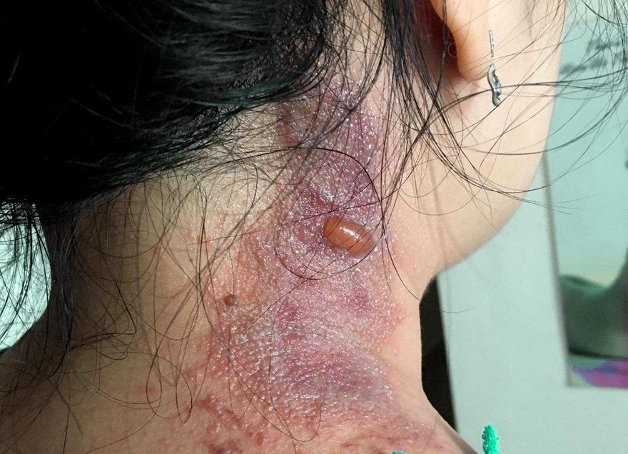 Nhiều bệnh nhân COVID-19 bị kiến ba khoang 'tấn công'