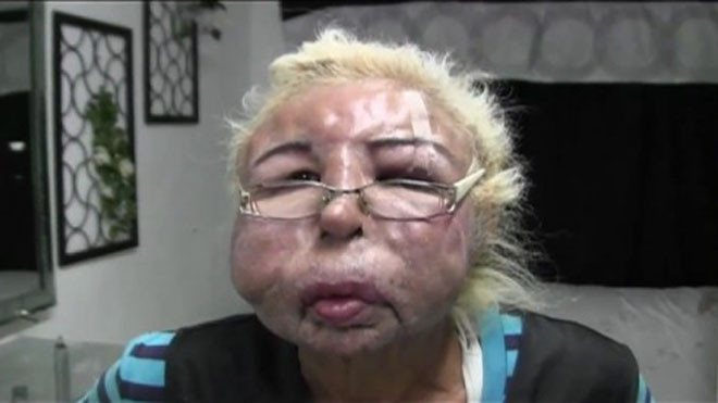 Khuôn mặt biến dạng vì tiêm dầu trẻ em