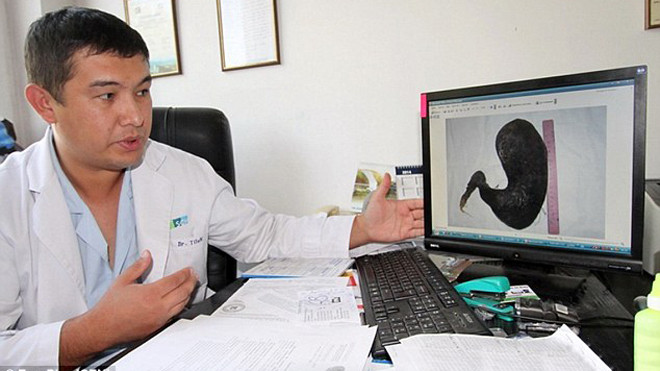 Hình ảnh búi tóc khổng lồ trong dạ dày cô gái được các bác sĩ lưu trữ.