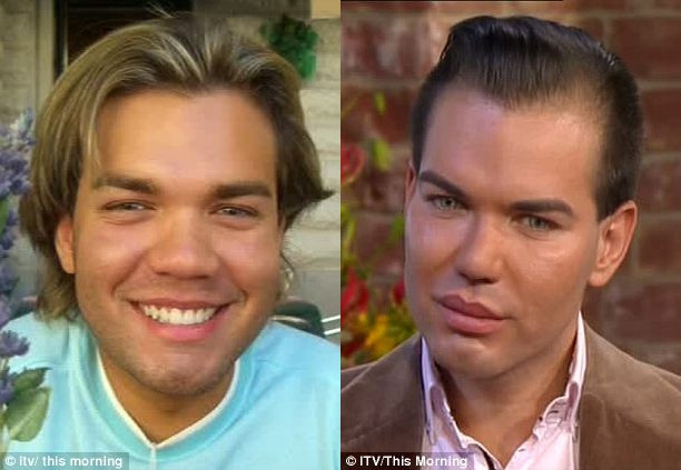 Khuôn mặt anh Rodrigo trước và sau thẩm mĩ.