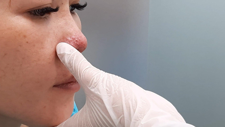 Mũi miệng bầm tím, mặt biến dạng sau tiêm chất làm đầy tại spa