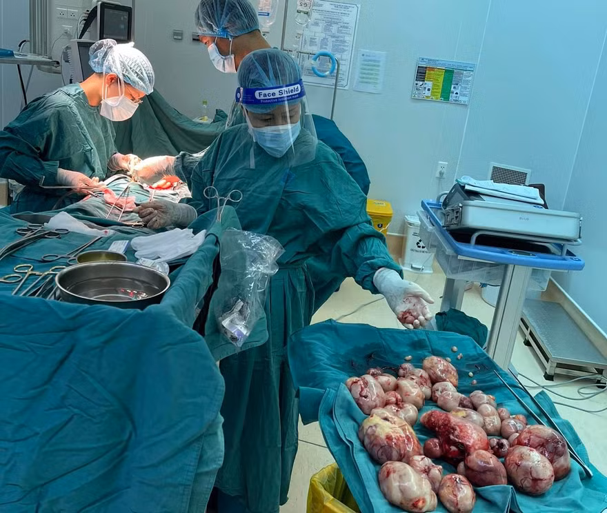 Hơn 100 khối bướu như 'quầy dừa' xếp đầy ổ bụng bệnh nhân
