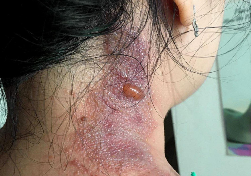 Cảnh báo hiểm họa kiến ba khoang 'tấn công' người trong mùa mưa