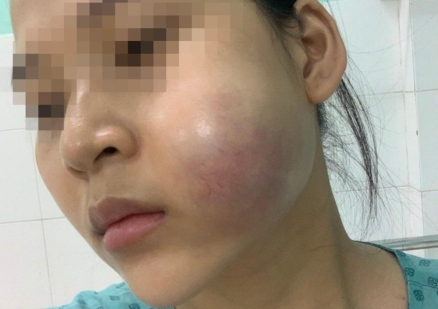 Bỏ tiền triệu 'nâng cấp sắc đẹp', thiếu nữ 'nhận' về gương mặt biến dạng 