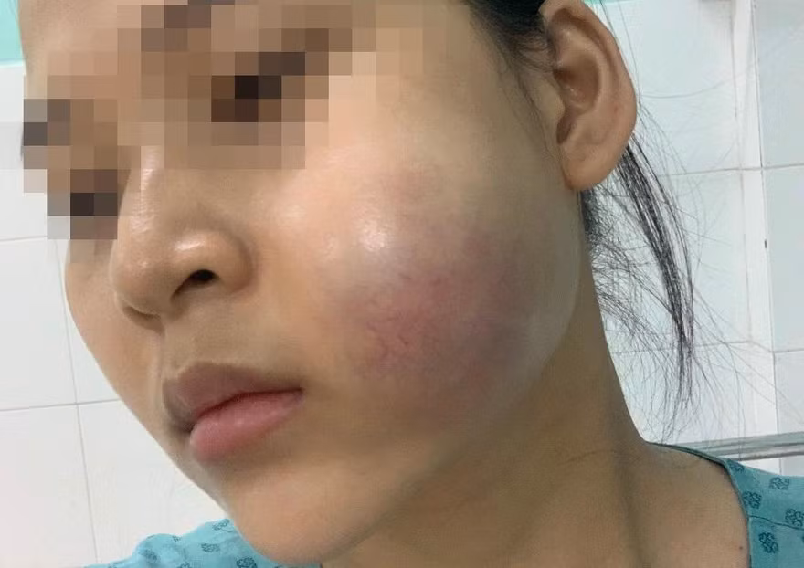Bỏ tiền triệu 'nâng cấp sắc đẹp', thiếu nữ 'nhận' về gương mặt biến dạng 