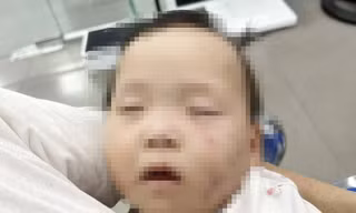 Hình ảnh cháu V với nhiều vết bầm tím trên mặt.