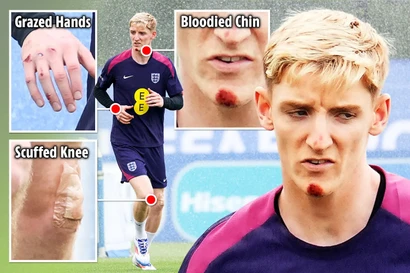 Ngôi sao tuyển Anh ‘te tua’, suýt thiệt mạng vì ngã xe đạp