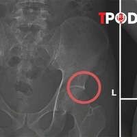 NÓNG 28/11: Vụ dùng búa đục xương để trục lợi bảo hiểm: Hé mở thủ đoạn của Tạ Minh Châu