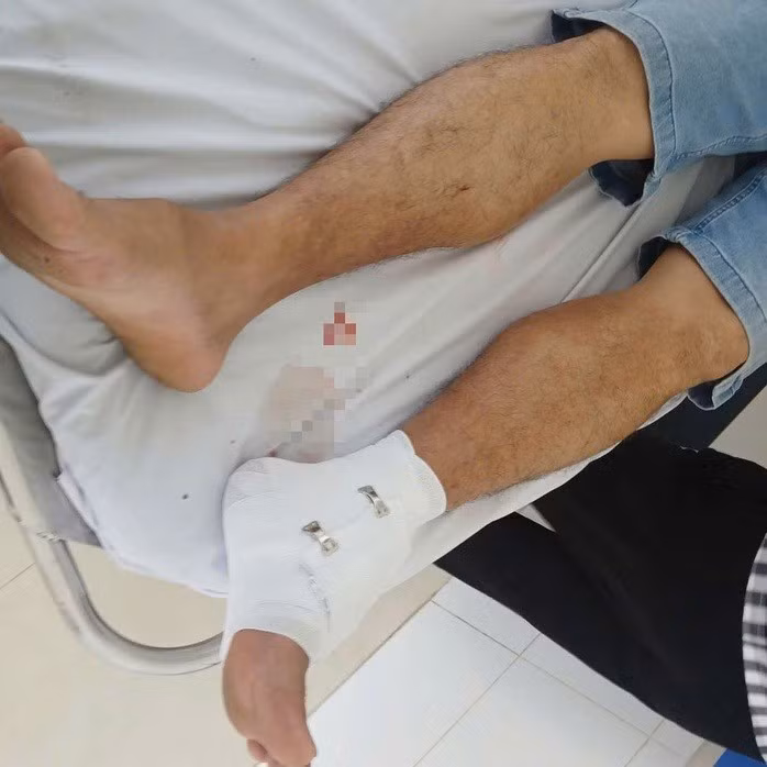 Một thầy giáo đi bệnh viện sau khi bị cá sấu cắn vào chân