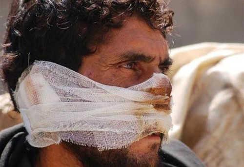 Người nông dân khốn khổ Mohamed bị Taliban cắt tai, xẻo mũi vì đi bầu Tổng thống.