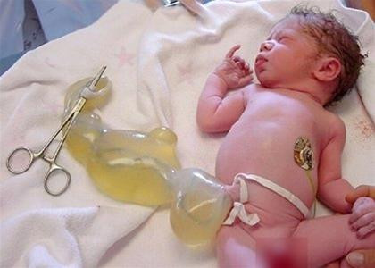 Các nhà khoa học Anh và Mỹ cho biết họ đã sản xuất được insulin từ tế bào gốc lấy từ dây rốn trẻ sơ sinh để điều trị bệnh tiểu đường. (Ảnh: www.neonet.ch)