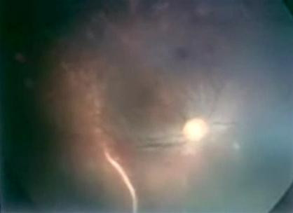 Hình ảnh giun soi được trong đáy mắt bệnh nhân T. (Nguồn : Viện mắt TƯ). Hình ảnh giun soi được trong đáy mắt bệnh nhân T. (Nguồn : Viện mắt TƯ).