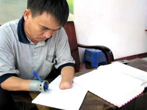 Anh Bắc đang viết bằng “cánh tay” mới của mình