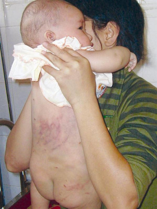 Bé Hoài bị thương tích đầy mình