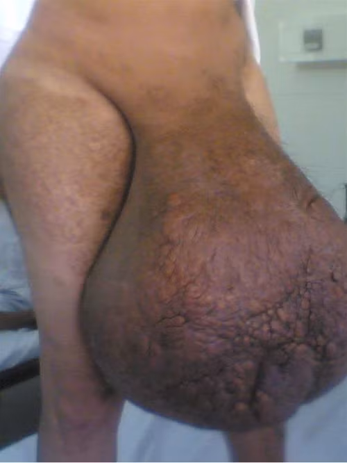 “Bìu voi”giun chỉ nặng 25 kg của ông Lê Văn Đ. Ảnh: Đàm Văn Cương