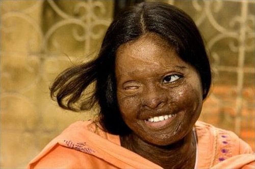 Hasina - một nạn nhân bị tạt axít.