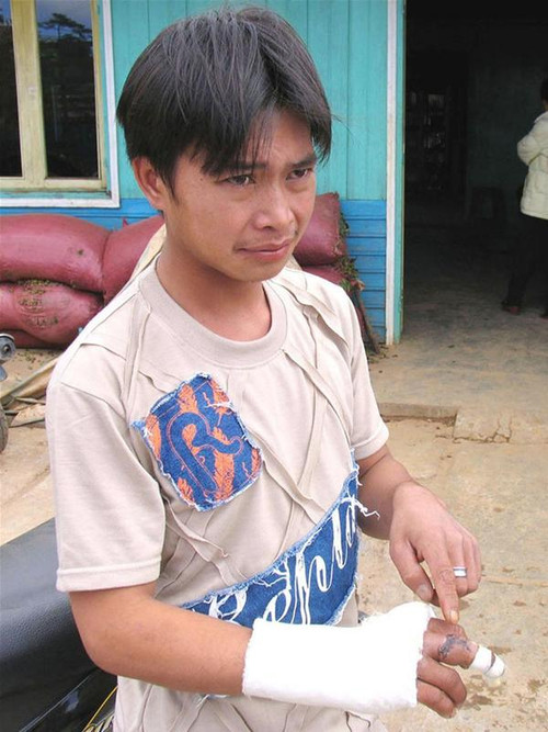 Minh bị đánh gãy xương bàn tay phải