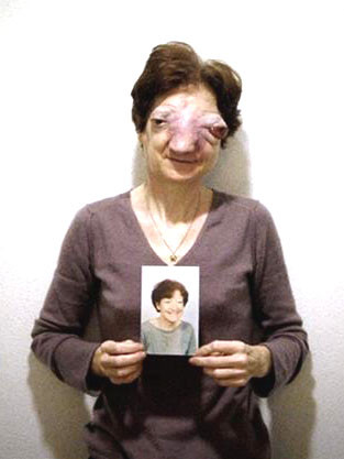 Bà Chantal Sebire xưa và trước khi qua đời tại nhà riêng