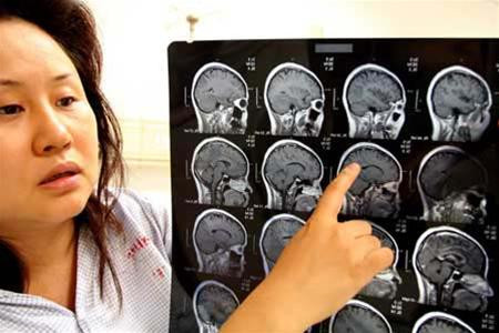 Một bệnh nhân với những con sán trong não (điểm trắng trên ảnh chụp cắt lớp)