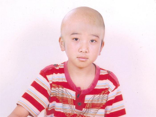 Điều trị bằng hóa chất khiến Vĩnh rụng hết tóc Điều trị bằng hóa chất khiến Vĩnh rụng hết tóc