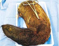 Búi tóc được lấy ra khỏi dạ dày