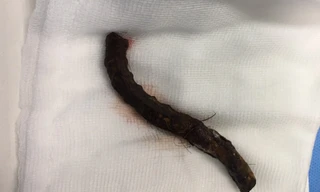 Bị thanh sắt phi 12 đâm xuyên sọ, người đàn ông may mắn thoát chết