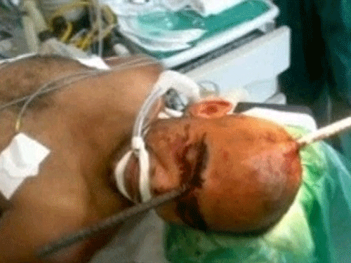 Thoát chết kỳ diệu khi bị thanh sắt đâm xuyên đầu