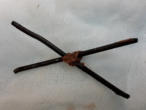 Hai cây đinh đã được các bác sĩ mổ lấy ra khỏi bụng bệnh nhân