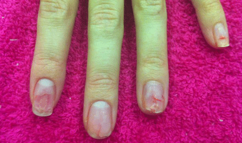 Móng tay Antonia sau khi gỡ móng giả ra. Móng tay Antonia sau khi gỡ móng giả ra