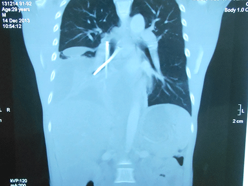 Hai cây đinh trong bụng bệnh nhân B