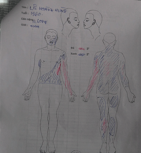 Phác đồ điều trị bỏng cho nhà báo Hoàng Hùng