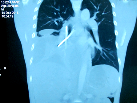 Nuốt 6 cây đinh dài 5 cm để trốn trại cai nghiện