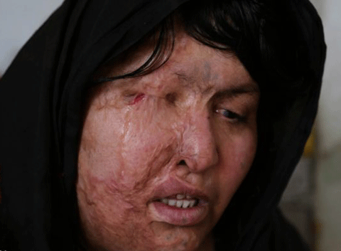 Sau khi bị tạt axit khuôn mặt Akhtara trở nên vô cùng đáng sợ. Sau khi bị tạt axit khuôn mặt Akhtara trở nên vô cùng đáng sợ