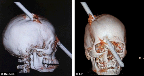 Hình ảnh chụp cắt lớp tổn thương của Eduardo Leite
