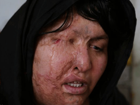 Xót xa người đàn bà bị tạt axit nát mặt