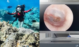 Cô gái ở TP.HCM bị thủng màng nhĩ sau khi lặn biển, tổn thương do thay đổi áp suất