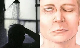 Nam thanh niên 23 tuổi bị liệt dây thần kinh số 7 vì một thói quen khó sửa