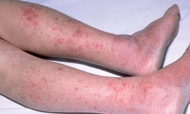 Cảnh báo loại bệnh có thể gây tử vong trong 24h, gia tăng thời điểm giao mùa