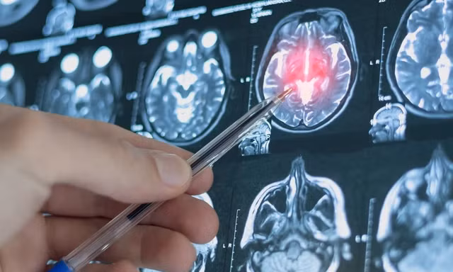 Mô hình AI dự đoán nguy cơ trầm cảm trước 4 năm