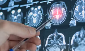 Mô hình AI dự đoán nguy cơ trầm cảm trước 4 năm