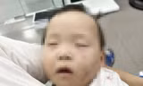Hình ảnh cháu V với nhiều vết bầm tím trên mặt.
