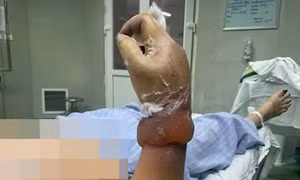 Người phụ nữ có nguy cơ bị cụt cẳng tay khi dựng cây nêu đón Tết