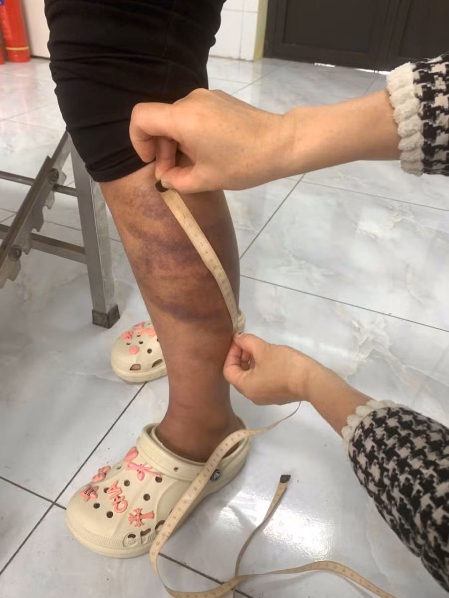 chau-phan-thi-m-t-bi-bo-de-danh-gay-thuong-tich-2.jpg