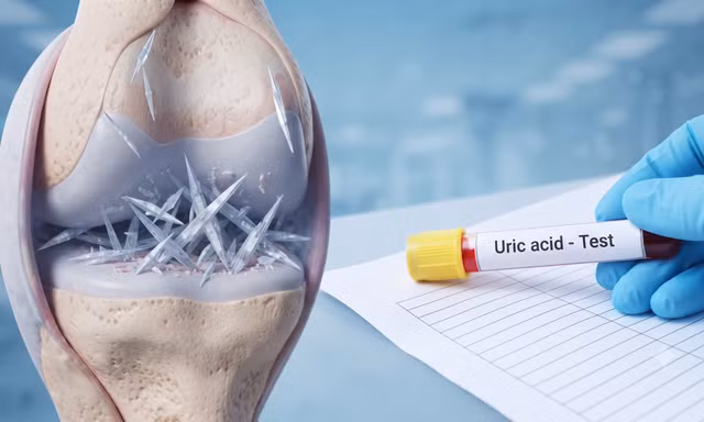 Axit uric cao tàn phá ngầm cơ thể thế nào dù không đau nhức?